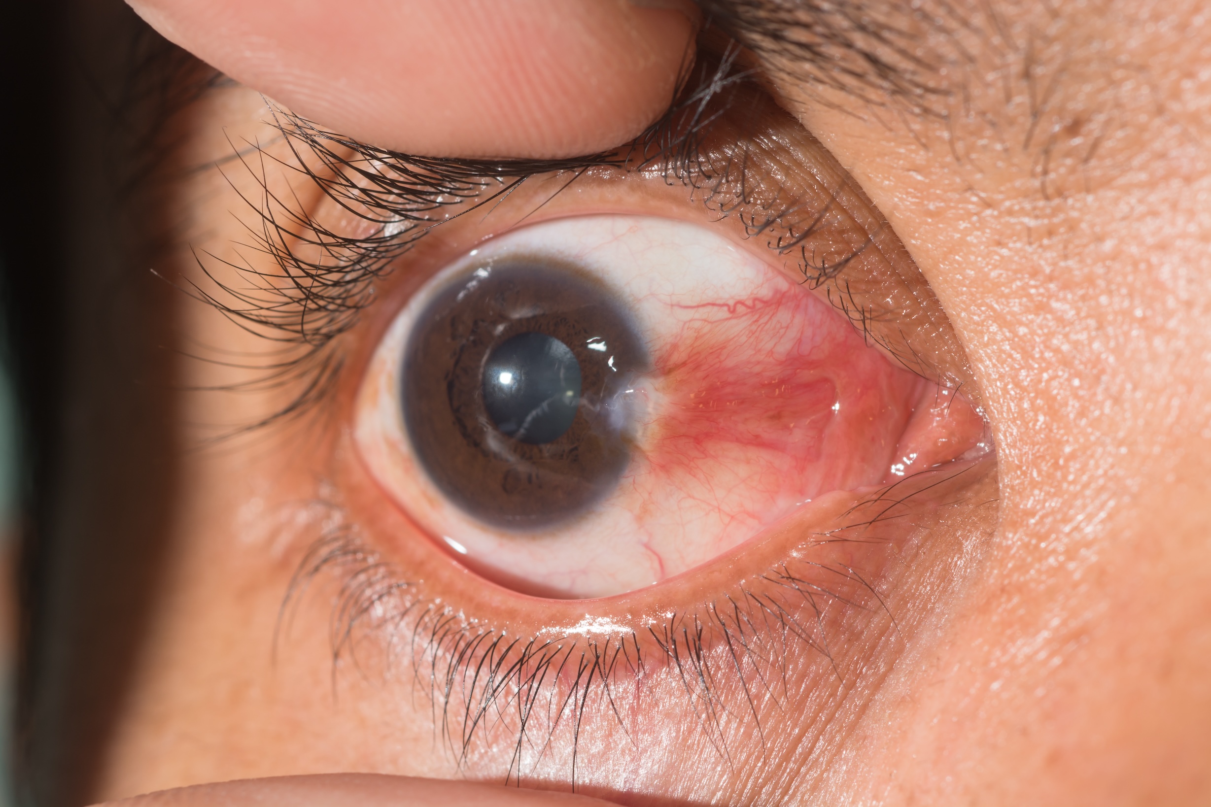 Close,Up,Of,The,Pterygium,During,Eye,Examination
